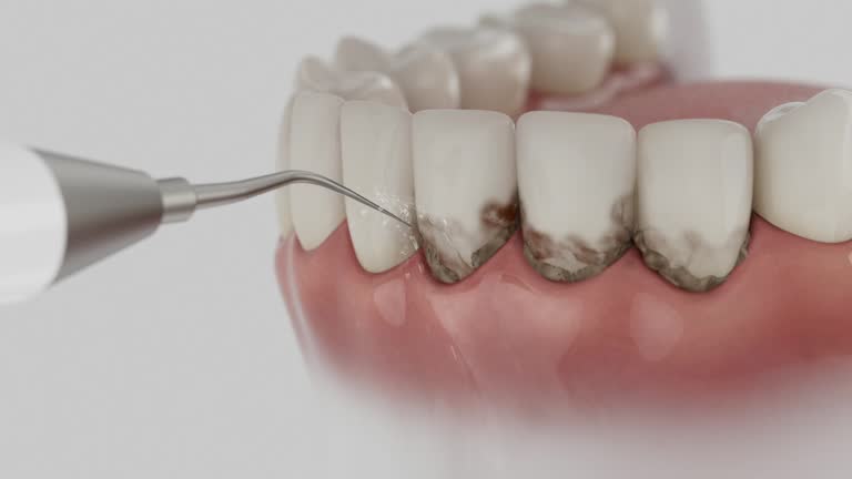 Trusted Wisdom Tooth Removal service in Plymouth, CA - Dentist Open Now